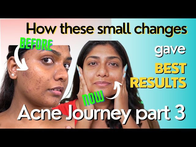 changes I made in Life to get clear skin | Acne journey part 3 11/22