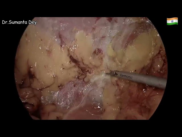 Laparoscopic TAPP plus for Large Lumbar Incisional Hernia (L4W3) by Dr.Sumanta Dey