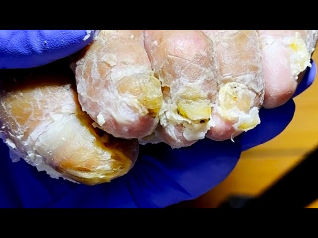 There Is A Lot Of Dead Skin On The Toenails, So Trim Them Thoroughly![Dr. Liu's Pedicur]