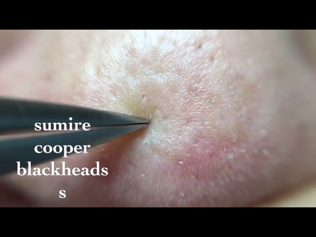 ❣ Acne Treatment Removal By tool   ║  Blackhead Removal Easy ║ Part 41 ✓