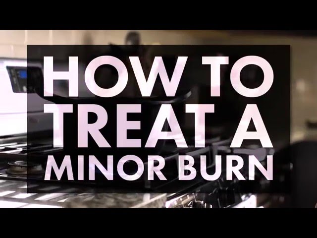 How to Treat a Minor Burn