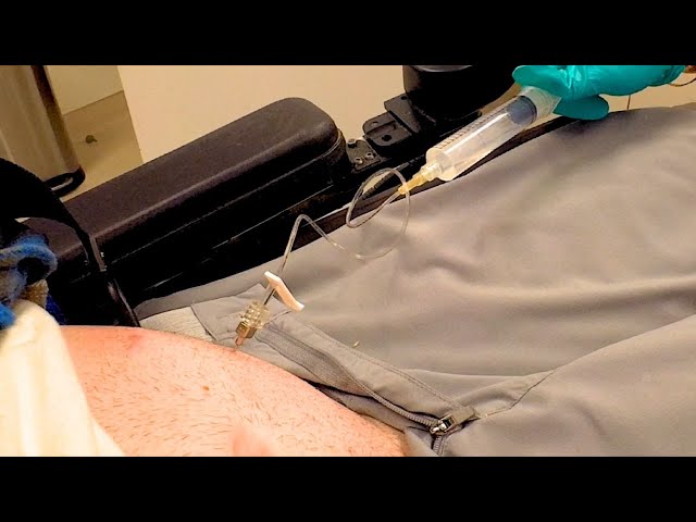 Quadriplegic Refills His Baclofen Pump