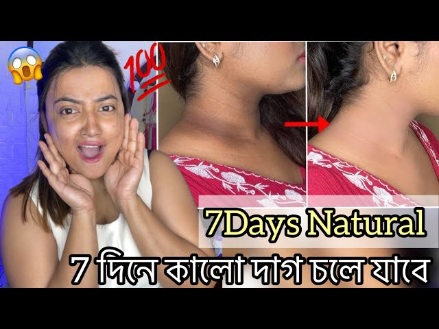 7 দিনে কালো দাগ চলে যাবে || 7Days Natural Neck Back Cream For Even toned and Smooth Nape