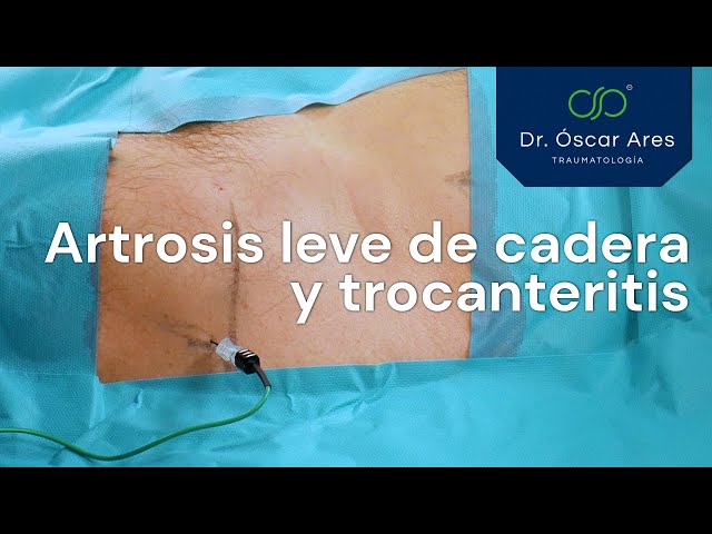 Artrosis leve de cadera y trocanteritis - Dr. Oscar Ares