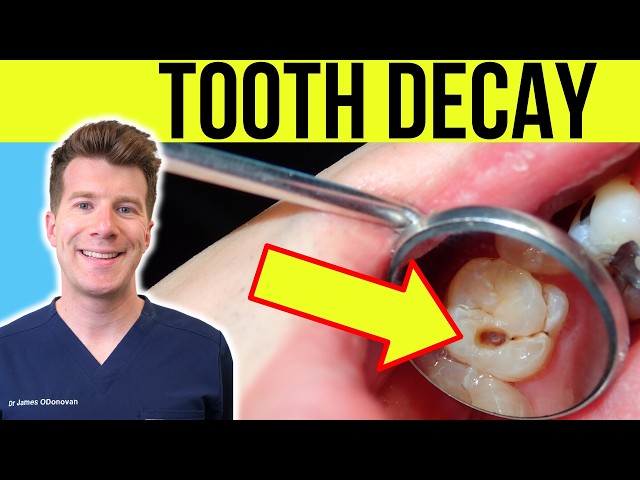 Doctor explains TOOTH DECAY (TOOTH CAVITY) - Causes, Symptoms and Treatment