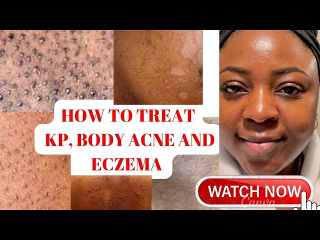 HOW TO TREAT- KP, BODY ACNE & ECZEMA