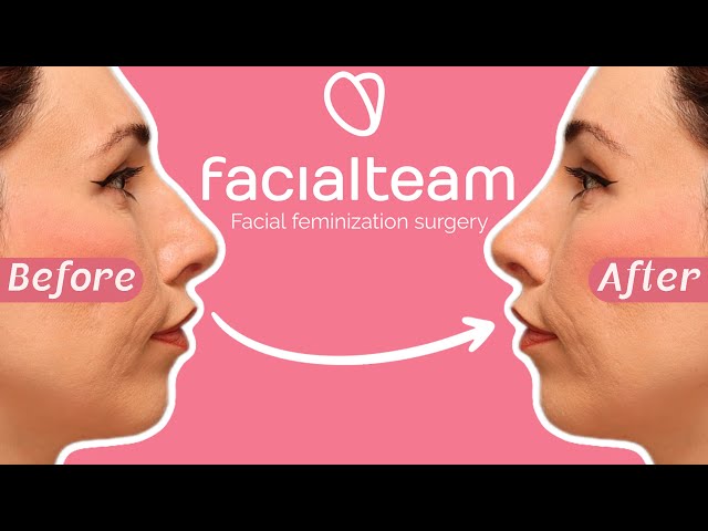 I'm having my FACE done! - [Facial feminization surgery with FACIAL TEAM]