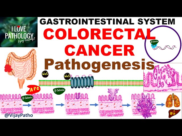 Colorectal carcinoma - Epidemiology, risk factors & Pathogenesis