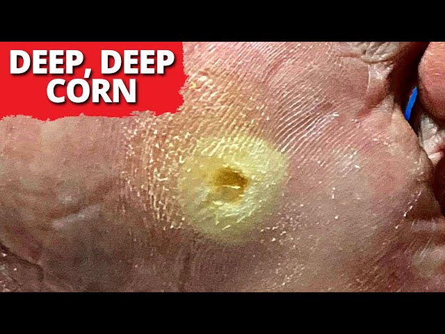 DEEP Seeded Corn Removal! (MUST WATCH)