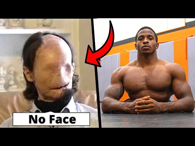 10 Unusual People With Missing Body Parts