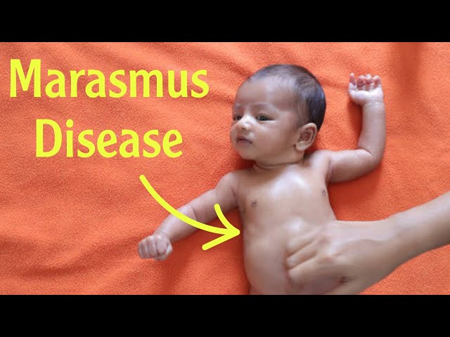 MARASMUS | CAUSES | SYMPTOMS | DIAGNOSIS | TREATMENT | MALNUTRITION IN CHILD in Hindi