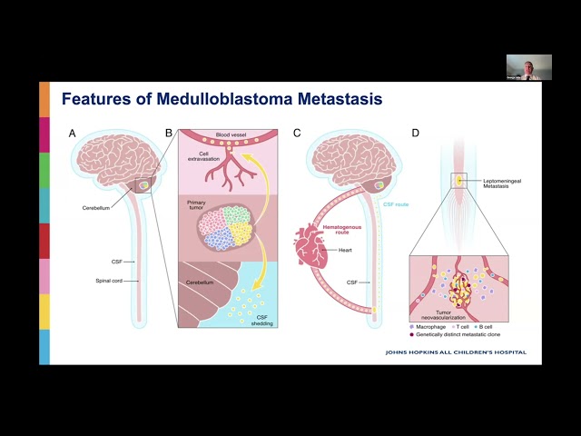 Masterclass Series: Medulloblastoma - Dr George I Jallo