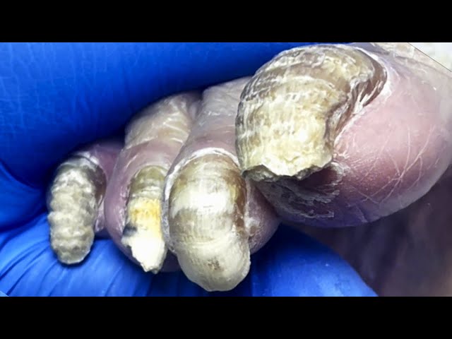 Extremely Long Toenails, Growing Curved【Pedicure Master Lin Jun】