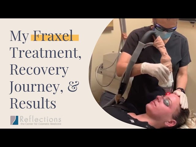 My #Fraxel Journey: Treatment, Recovery Diary, & Results