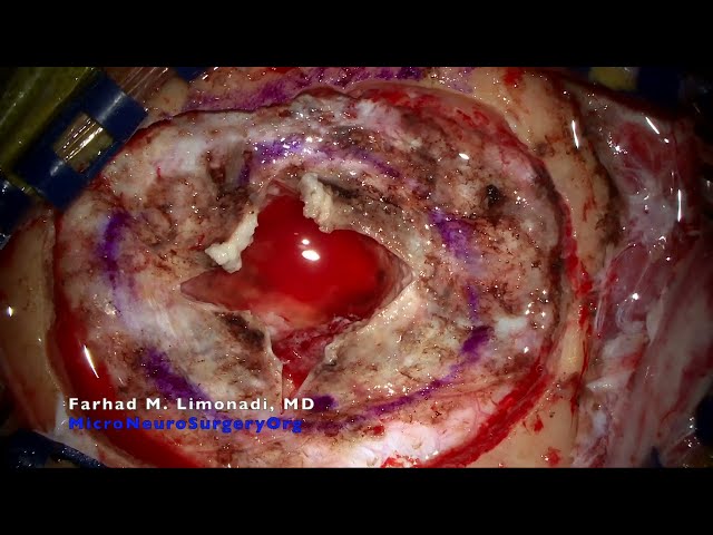 Surgical resection of atypical meningioma causing speech deficit.  Brain tumor surgery.