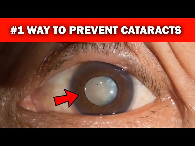 How to Prevent Cataracts Naturally - #1 Tip to Avoid Cataracts Forever