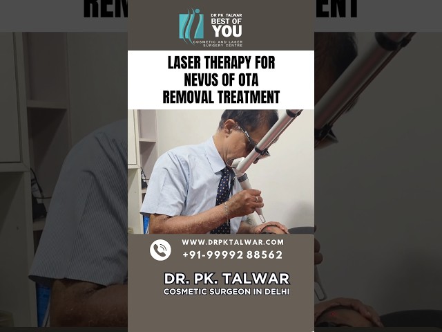 Laser Therapy for Nevus of OTA Removal Treatment | Nevus of OTA in Delhi | Dr. PK Talwar