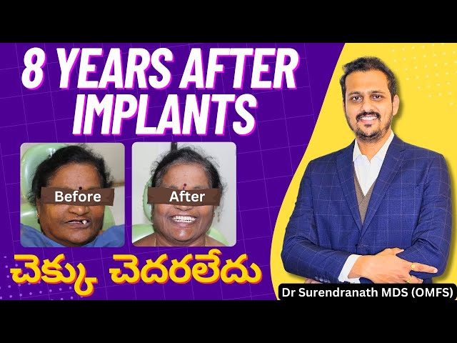 8 Years Later: Full Mouth Dental Implants Still Perfect