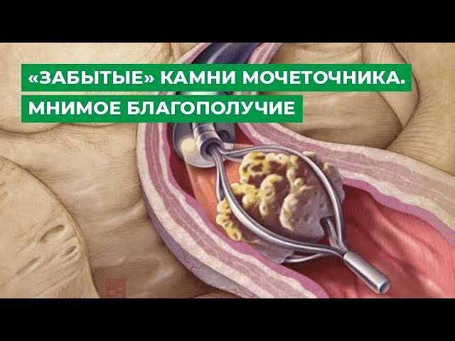 «Забытые» камни мочеточника. Мнимое благополучие.