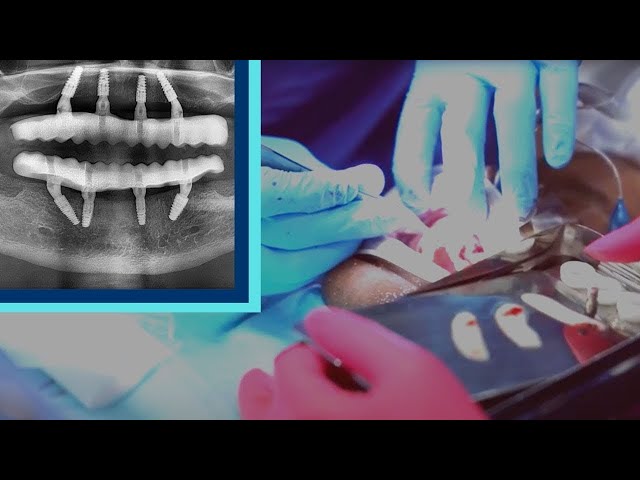 How Long Does It Take To Heal After Dental Implant Surgery?