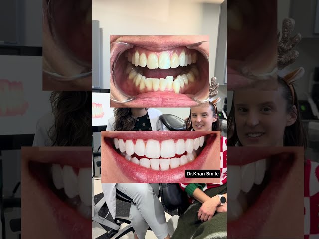 Invisalign Reaction and Review with Dr. Khan!