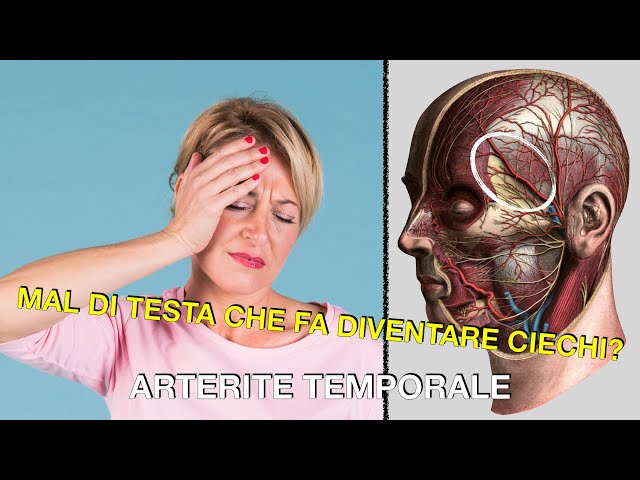 Mal di testa che fa diventare ciechi? Arterite temporale.