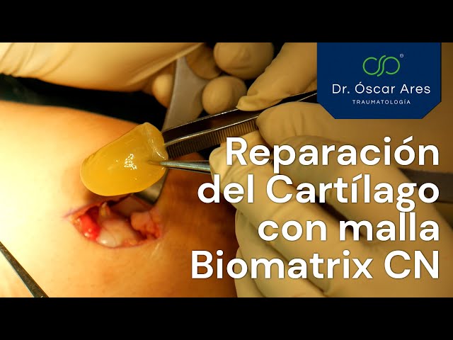 Reparación del Cartílago con malla Biomatrix CN - Dr. Oscar Ares