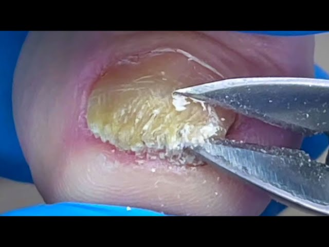 Removes yellow impurities from under toenails【Pedicure Master Lin Jun】