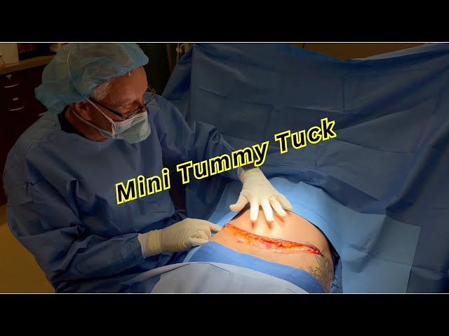 Mini Tummy Tuck | Orange County Plastic Surgery