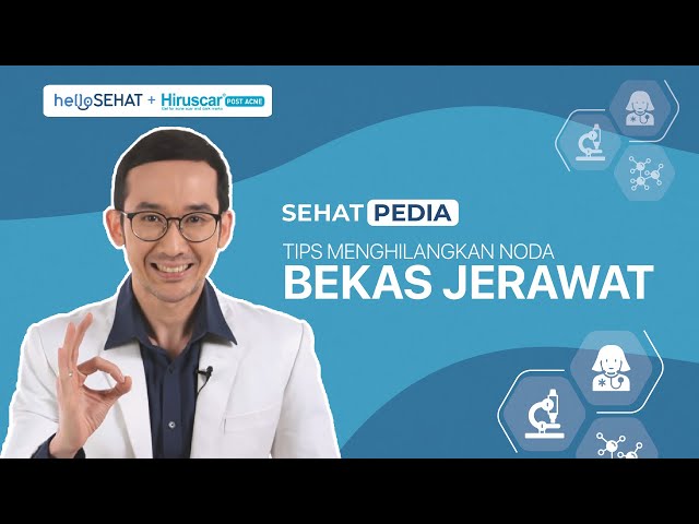 Tips Menghilangkan Noda Bekas Jerawat