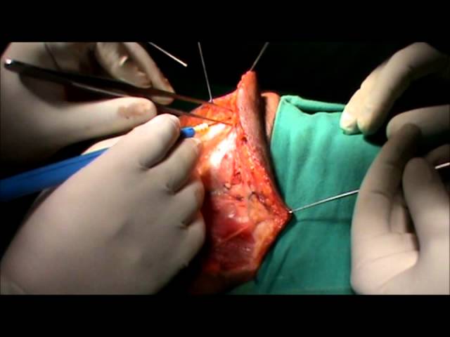 Radical Neck Dissection (HD)-  Head Neck Surgery- Dr Rajnish Talwar