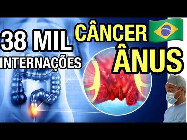 CÂNCER DE ÂNUS: 38 MIL INTERNAÇÕES EM 10 ANOS