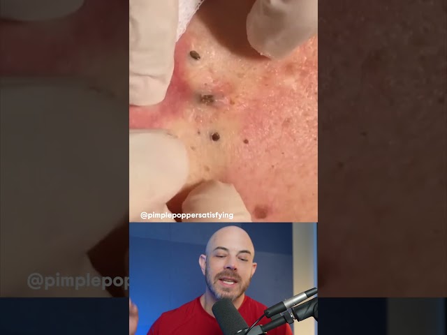 Derm reacts to cystic blackhead removal! #blackheadremoval #cystremoval #dermreacts