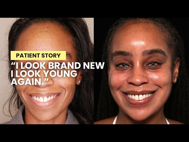 Dr. Qazi Pigmentation + Skin Restoration Patient Testimonial