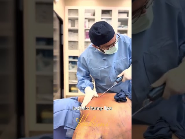 General Anesthesia Case Pt. 2: Buffalo Hump Removal, Arm Lipo, Brazilian Butt Lift (BBL)