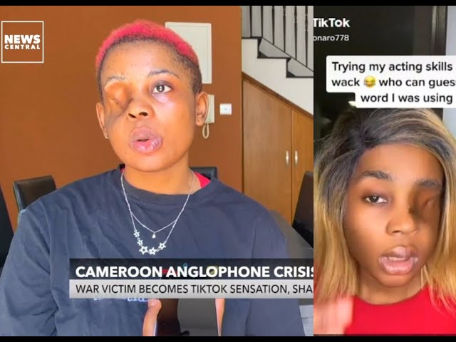 Tiktok Sensation Who Lost Her Eye During The Cameroon Anglophone Crisis Shares Experience