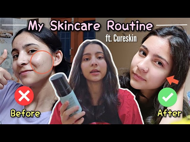 Skincare Routine for Acne prone skin ✨ Skincare with Cureskin products 🫧 Cureskin Kit review 🧚‍♀️