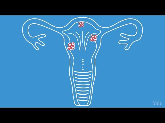 Uterine Fibroids - Yale Medicine Explains