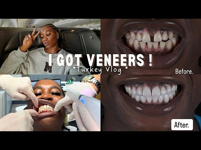 BEST VENEERS EVER! I got my teeth done in turkey with Prime Dental—VLOG