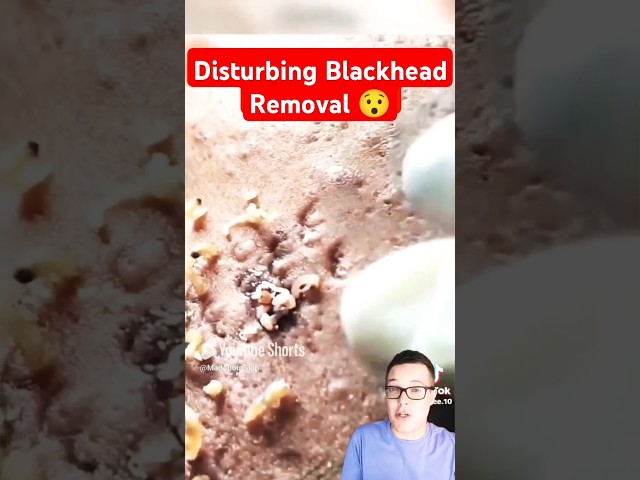 Disturbing BLACKHEADS REMOVAL #shorts