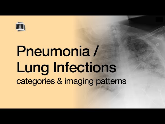 Pneumonia / Lung Infections