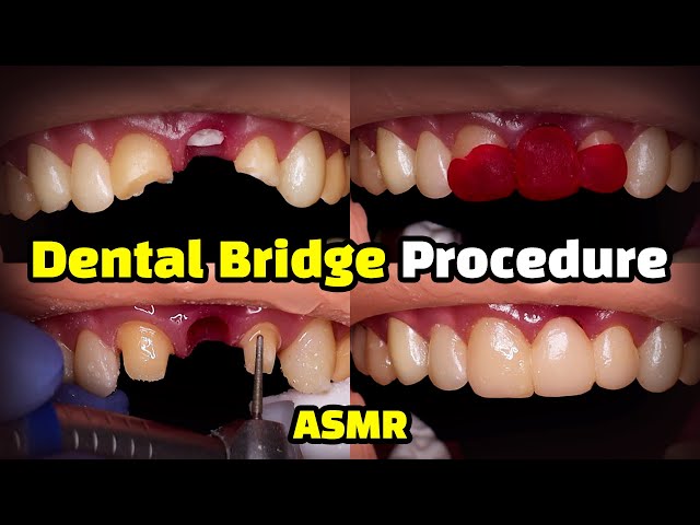 Dental Bridge Procedure