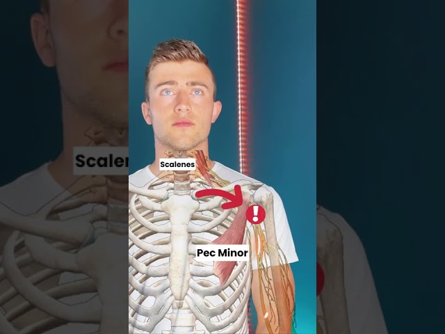 Thoracic Outlet Syndrome (TOS) AKA, tingly hands