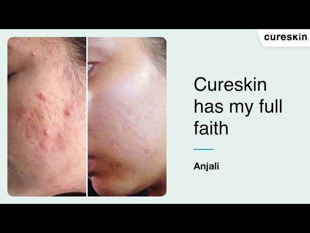 "Cureskin has restored my confidence" - Anjali | Cureskin review