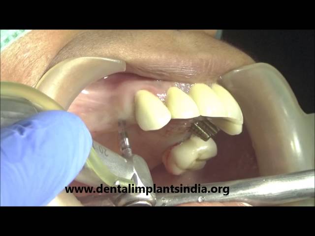 Lower full arch basal implants(genxt) surgery and upper molars-FULL SURGERY VIDEO