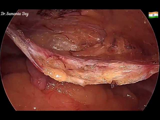 Spigelian Hernia: Laparoscopic TAPP plus by Dr.Sumanta Dey