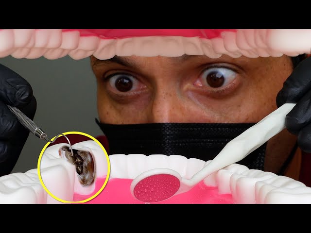 Amazing Dentist And The Tooth Pain | Satisfying Indirect Tooth Restoration