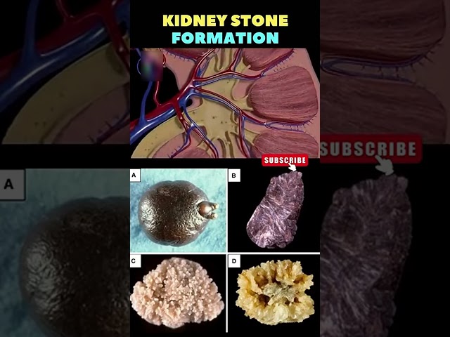 Kidney Stone formation Animation