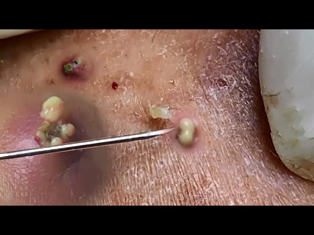 Big Cystic Acne Blackheads Extraction Blackheads & Milia, Whiteheads Removal Pimple Popping #089