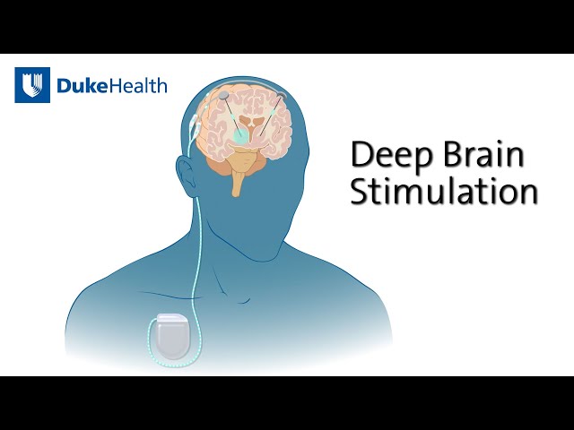 Deep Brain Stimulation (DBS) for Epilepsy | Duke Health